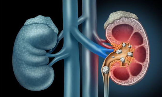 Batu Ginjal yang Sering Tidak Disadari, Kenali 4 Tandanya