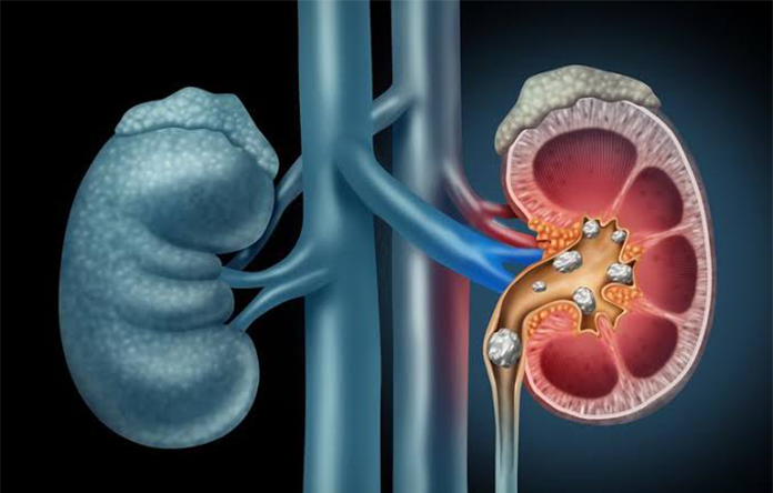 Batu Ginjal yang Sering Tidak Disadari, Kenali 4 Tandanya
