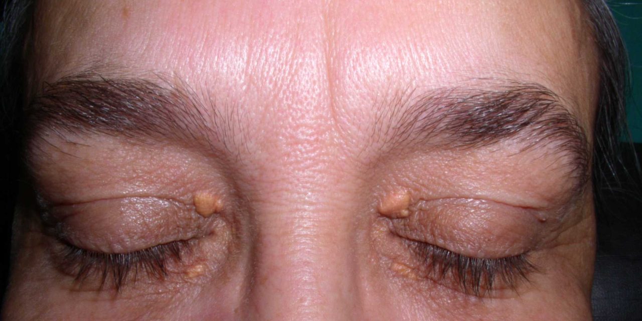 Xanthoma, Penumpukan Lemak pada Kulit yang Perlu Di waspadai