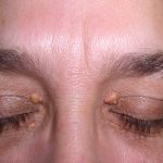 Xanthoma, Penumpukan Lemak pada Kulit yang Perlu Di waspadai