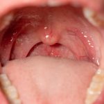 Radang Amandel Di Sebabkan Oleh Virus Rhinovirus