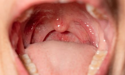 Radang Amandel Di Sebabkan Oleh Virus Rhinovirus