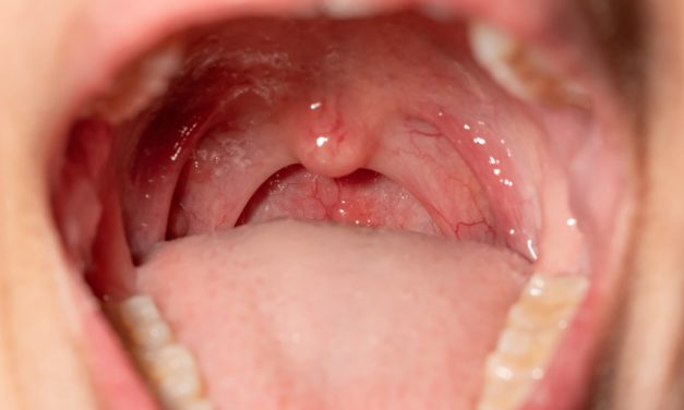 Radang Amandel Di Sebabkan Oleh Virus Rhinovirus