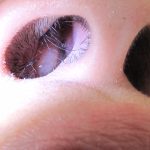 Polip Hidung Bisa Menyebabkan Gangguan Pernapasan Serius