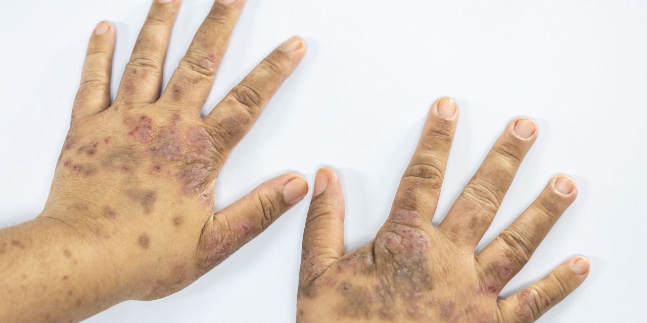 Cara Mengobati Lupus Yang Kerap Sekali Kambuh