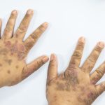 Cara Mengobati Lupus Yang Kerap Sekali Kambuh