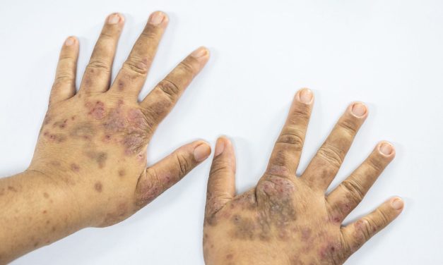 Cara Mengobati Lupus Yang Kerap Sekali Kambuh