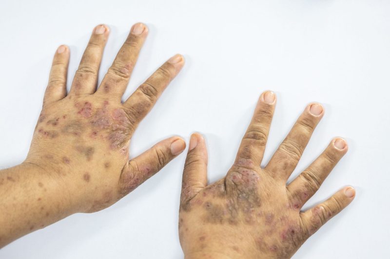 Cara Mengobati Lupus